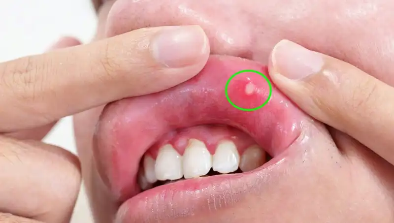 B Vitamini Eksikliği: Belirtilerini Tanıyın ve Sağlığınızı Koruyun