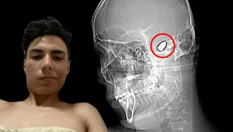 Kafasında Patlayıcı Bomba Taşıyan Genç, Hayatı İle Oynuyor